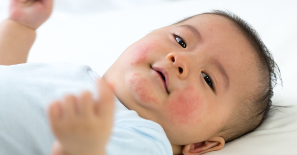 Infectious Diseases in Children