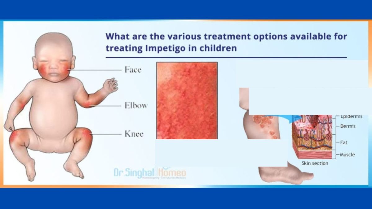 Skin Diseases In Childrens-Dr Priyanka Jain-Bachpan Kids Care Clinic (4)