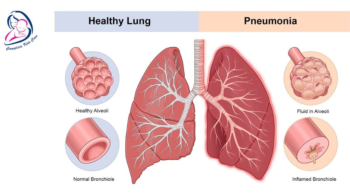 Pneumonia - Dr Priyanka Jain - Vaccination Specialist (3)
